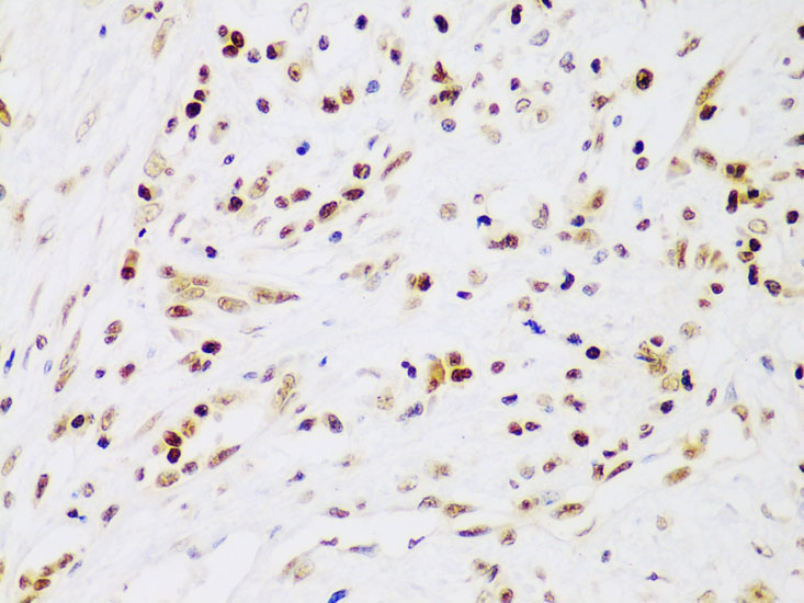Immunohistochemistry of paraffin-embedded Human liver cancer using IKK beta Polyclonal Antibody at dilution of  1:100 (40x lens).