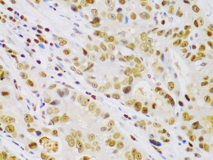 Immunohistochemistry of paraffin-embedded Human gastric cancer using IKK beta Polyclonal Antibody at dilution of  1:100 (40x lens).