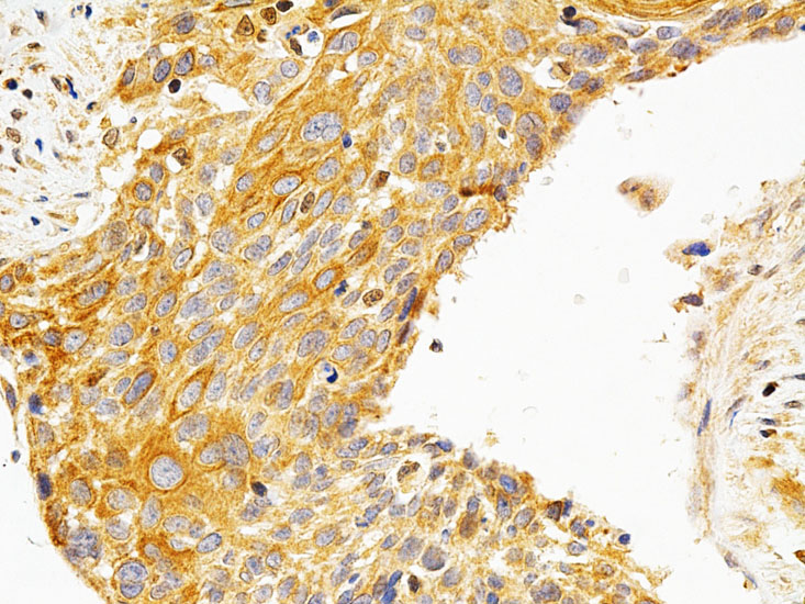 Immunohistochemistry of paraffin-embedded Human esophageal cancer using PRKCE Polyclonal Antibody at dilution of  1:200 (40x lens).