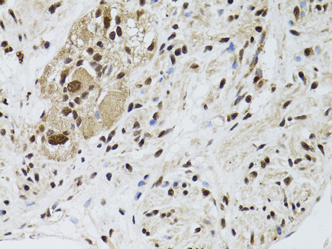 Immunohistochemistry of paraffin-embedded Human colon carcinoma using LKB1 Polyclonal Antibody at dilution of  1:100 (40x lens).