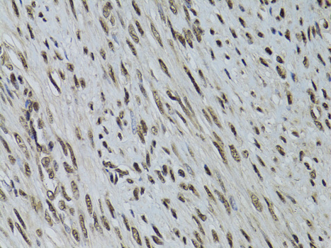 Immunohistochemistry of paraffin-embedded Human uterine cancer using LKB1 Polyclonal Antibody at dilution of  1:100 (40x lens).