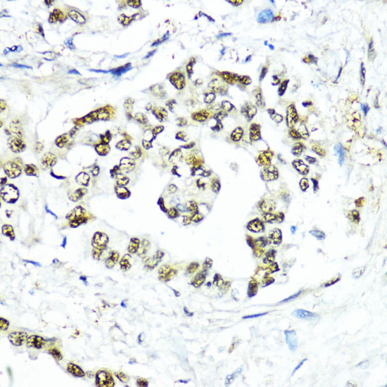 Immunohistochemistry of paraffin-embedded Human lung cancer using SUMO1 Polyclonal Antibody at dilution of  1:200 (40x lens).