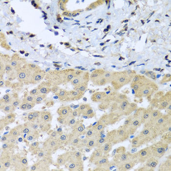 Immunohistochemistry of paraffin-embedded Human liver damage using LETMD1 Polyclonal Antibody at dilution of  1:100 (40x lens).