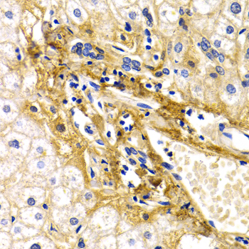 Immunohistochemistry of paraffin-embedded Human liver damage using CFH Polyclonal Antibody at dilution of  1:200 (40x lens).