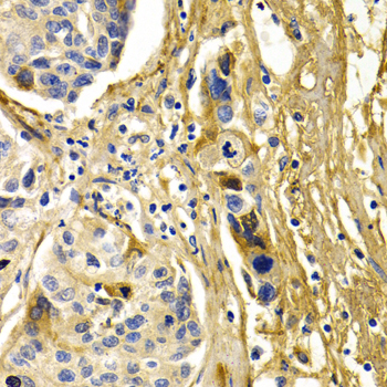 Immunohistochemistry of paraffin-embedded Human liver cancer using CFH Polyclonal Antibody at dilution of  1:200 (40x lens).