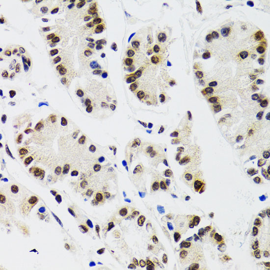 Immunohistochemistry of paraffin-embedded Human gastric cancer using EDF1 Polyclonal Antibody at dilution of  1:100 (40x lens).