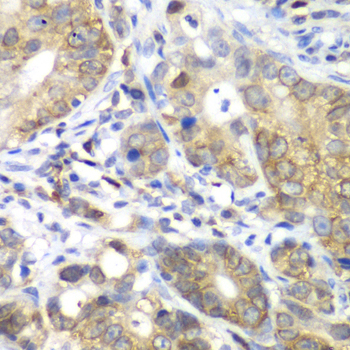 Immunohistochemistry of paraffin-embedded Human gastric cancer using CDK1 Polyclonal Antibody at dilution of  1:100 (40x lens).