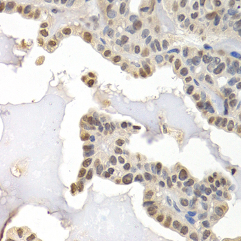 Immunohistochemistry of paraffin-embedded Human thyroid cancer using GTF2F1 Polyclonal Antibody at dilution of  1:200 (40x lens).