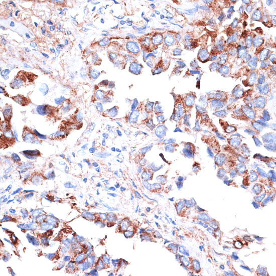 Immunohistochemistry of paraffin-embedded Human lung cancer using TIM-3/HAVCR2 Polyclonal Antibody at dilution of  1:200 (40x lens).