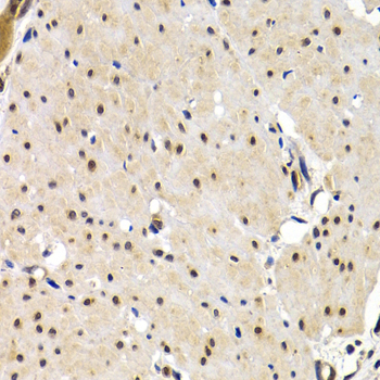 Immunohistochemistry of paraffin-embedded Human gastric cancer using IRF2 Polyclonal Antibody at dilution of  1:200 (40x lens).