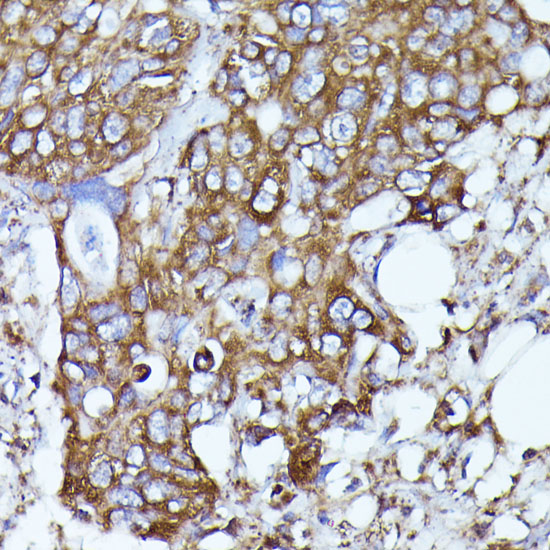 Immunohistochemistry of paraffin-embedded Human colon carcinoma using N-WASP Polyclonal Antibody at dilution of  1:100 (40x lens).