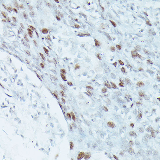 Immunohistochemistry of paraffin-embedded Human breast cancer using MEF2C Polyclonal Antibody at dilution of  1:100 (40x lens).
