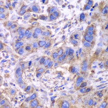 Immunohistochemistry of paraffin-embedded Human esophageal cancer using SDHA Polyclonal Antibody at dilution of  1:100 (40x lens).