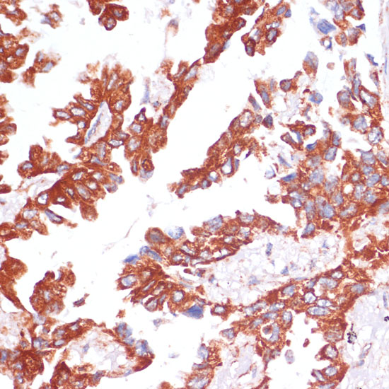 Immunohistochemistry of paraffin-embedded Human lung cancer using Caspase-9 Polyclonal Antibody at dilution of  1:100 (40x lens).