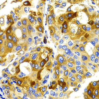 Immunohistochemistry of paraffin-embedded Human liver cancer using CDK20 Polyclonal Antibody at dilution of  1:100 (40x lens).