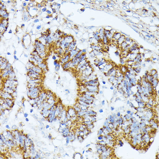 Immunohistochemistry of paraffin-embedded Human colon carcinoma using TRAP1 Polyclonal Antibody at dilution of  1:100 (40x lens).