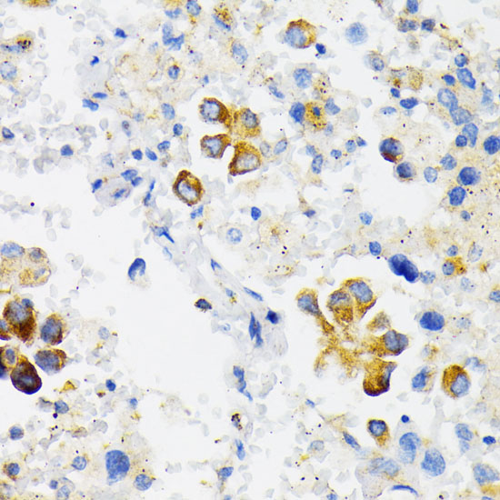 Immunohistochemistry of paraffin-embedded Human lung cancer using USO1 Polyclonal Antibody at dilution of  1:100 (40x lens).