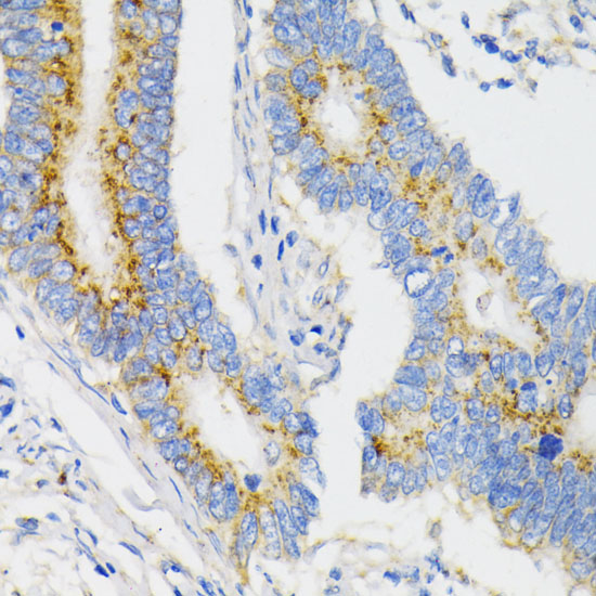 Immunohistochemistry of paraffin-embedded Human colon carcinoma using USO1 Polyclonal Antibody at dilution of  1:100 (40x lens).