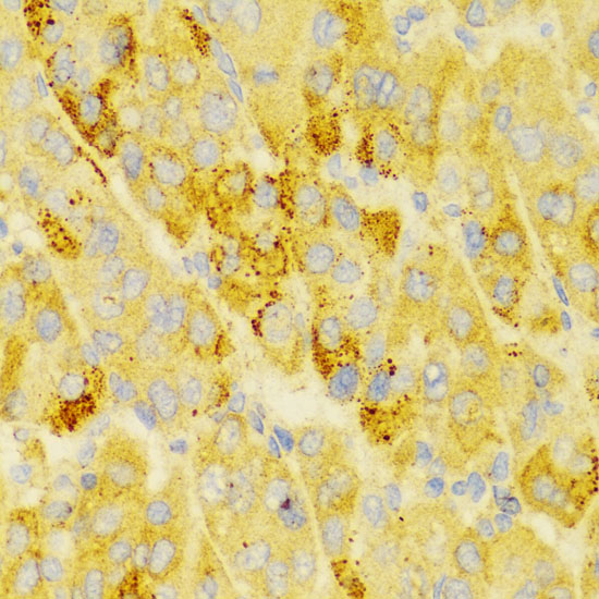 Immunohistochemistry of paraffin-embedded Human liver cancer using LAMP3 Polyclonal Antibody at dilution of  1:100 (40x lens).