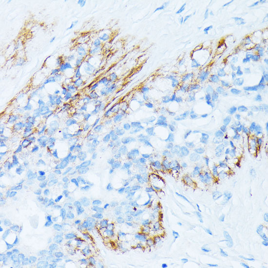 Immunohistochemistry of paraffin-embedded Human breast cancer using TPM2 Polyclonal Antibody at dilution of  1:100 (40x lens).