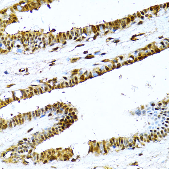 Immunohistochemistry of paraffin-embedded Human breast using NFkB p100 / p52 Polyclonal Antibody at dilution of  1:100 (40x lens).