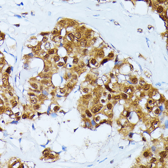 Immunohistochemistry of paraffin-embedded Human esophageal cancer using UBC Polyclonal Antibody at dilution of  1:100 (40x lens).