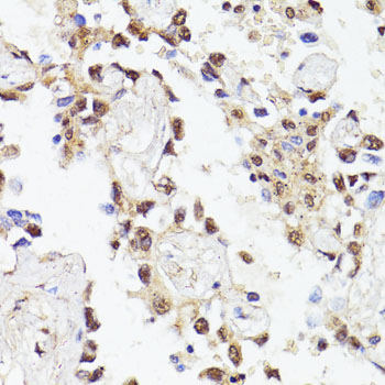 Immunohistochemistry of paraffin-embedded Human lung cancer using Twist Polyclonal Antibody at dilution of  1:100 (40x lens).