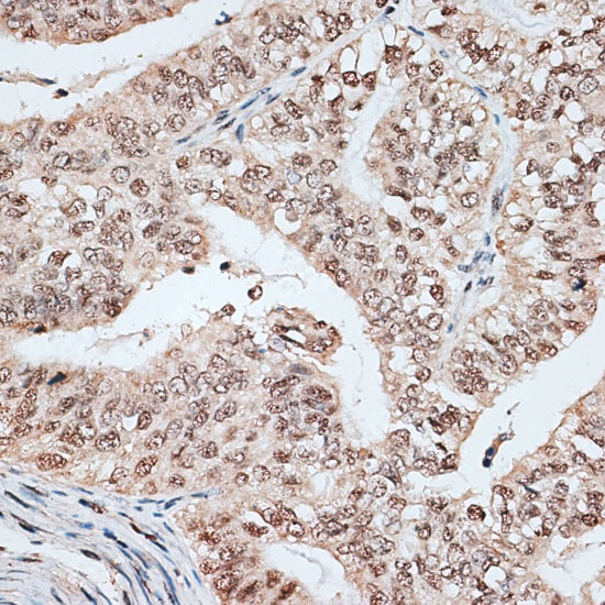 Immunohistochemistry of paraffin-embedded Human endometrium cancer using RBM17 Polyclonal Antibody at dilution of  1:100 (40x lens).