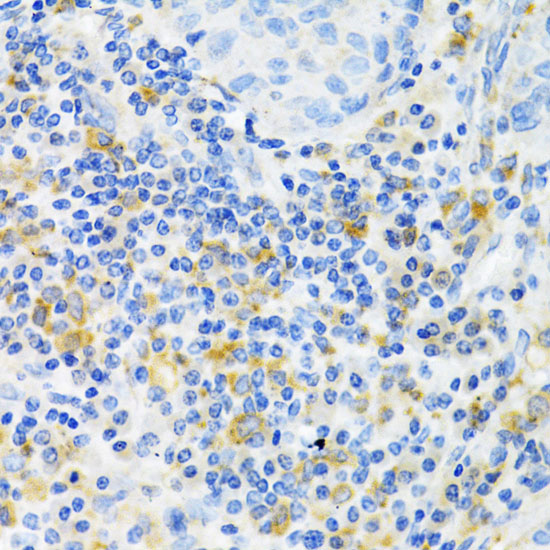 Immunohistochemistry of paraffin-embedded Human lung cancer using PAK1 Polyclonal Antibody at dilution of  1:100 (40x lens).