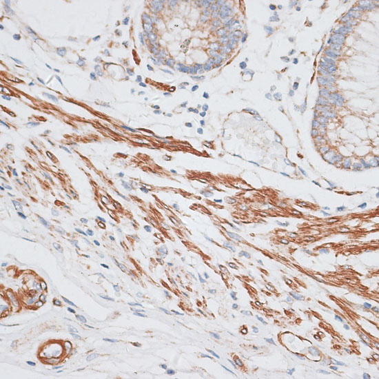 Immunohistochemistry of paraffin-embedded Human colon carcinoma using GRK5 Polyclonal Antibody at dilution of  1:100 (40x lens).
