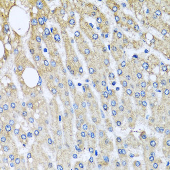 Immunohistochemistry of paraffin-embedded Human liver damage using UQCRC2 Polyclonal Antibody at dilution of  1:100 (40x lens).