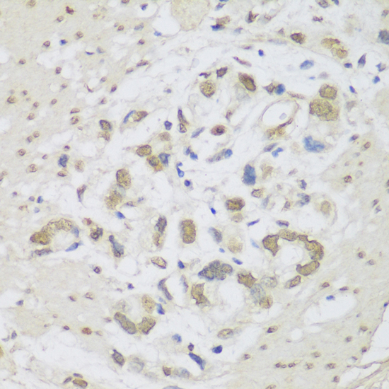 Immunohistochemistry of paraffin-embedded Human gastric cancer using DHX38 Polyclonal Antibody at dilution of  1:150 (40x lens).