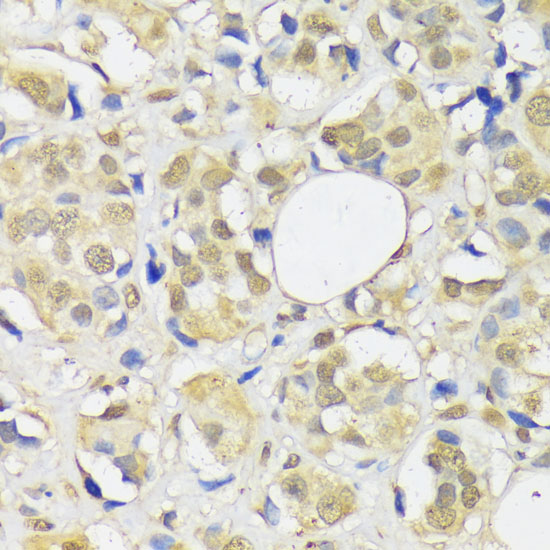 Immunohistochemistry of paraffin-embedded Human breast cancer using ADRM1 Polyclonal Antibody at dilution of  1:100 (40x lens).