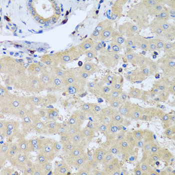 Immunohistochemistry of paraffin-embedded Human liver damage using COTL1 Polyclonal Antibody at dilution of  1:100 (40x lens).