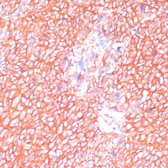 Immunohistochemistry of paraffin-embedded Human oophoroma using MOB4 Polyclonal Antibody at dilution of  1:100 (40x lens).