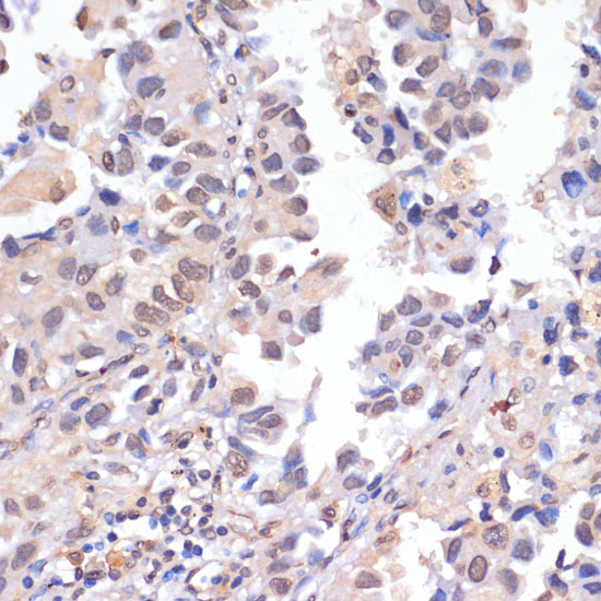 Immunohistochemistry of paraffin-embedded Human lung cancer using PIDD Polyclonal Antibody at dilution of  1:100 (40x lens).