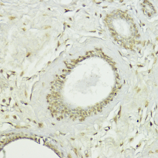 Immunohistochemistry of paraffin-embedded Human breast using Snail Polyclonal Antibody at dilution of  1:100 (40x lens).