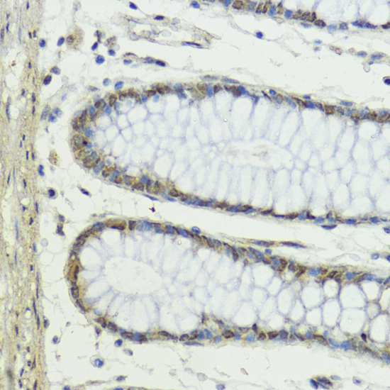 Immunohistochemistry of paraffin-embedded Human colon using Snail Polyclonal Antibody at dilution of  1:100 (40x lens).