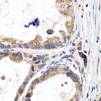 Immunohistochemistry of paraffin-embedded Human stomach cancer using FABP3 Polyclonal Antibody at dilution of  1:200 (40x lens).