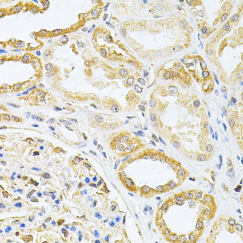 Immunohistochemistry of paraffin-embedded Human kidney cancer using VAPB Polyclonal Antibody at dilution of  1:200 (40x lens).