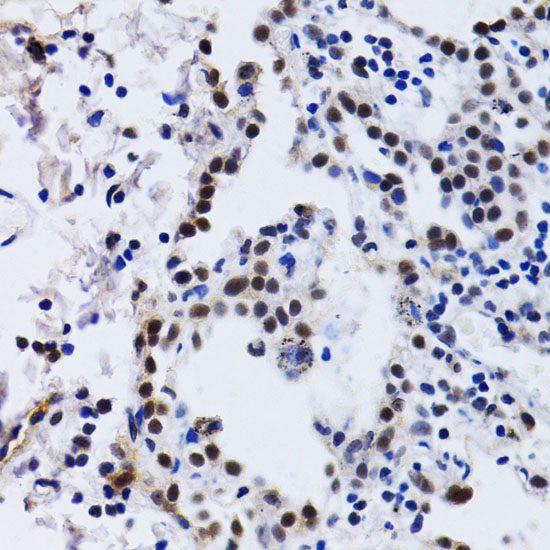 Immunohistochemistry of paraffin-embedded Human lung cancer using ID3 Polyclonal Antibody at dilution of  1:200 (40x lens).