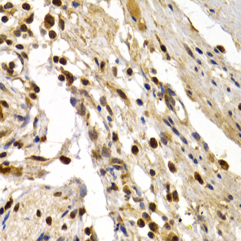 Immunohistochemistry of paraffin-embedded Human colon damage using TFDP1 Polyclonal Antibody at dilution of  1:200 (40x lens).