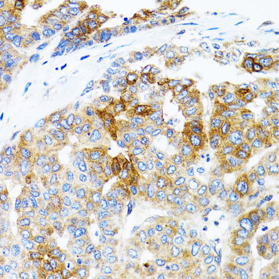 Immunohistochemistry of paraffin-embedded Human liver cancer using STAT3 Polyclonal Antibody at dilution of  1:100 (40x lens).