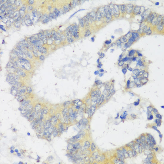 Immunohistochemistry of paraffin-embedded Human colon carcinoma using Snail Polyclonal Antibody at dilution of  1:100 (40x lens).
