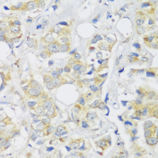 Immunohistochemistry of paraffin-embedded Human breast cancer using Snail Polyclonal Antibody at dilution of  1:100 (40x lens).