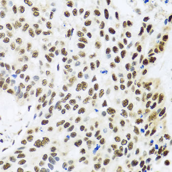 Immunohistochemistry of paraffin-embedded Human lung cancer using FUBP1 Polyclonal Antibody at dilution of  1:100 (40x lens).