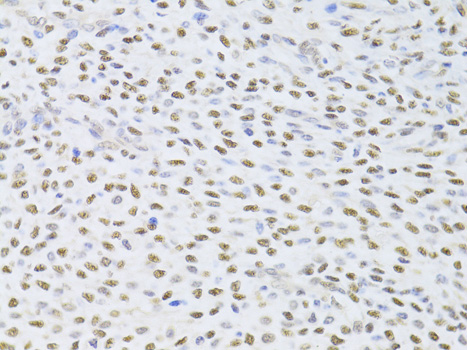 Immunohistochemistry of paraffin-embedded Human adenomyosis using FKBP4 Polyclonal Antibody at dilution of  1:100 (40x lens).