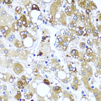 Immunohistochemistry of paraffin-embedded Human liver damage using IL4 Polyclonal Antibody at dilution of  1:100 (40x lens).