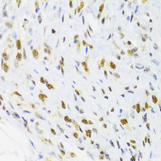 Immunohistochemistry of paraffin-embedded Human gastric cancer using DOK1 Polyclonal Antibody at dilution of  1:100 (40x lens).