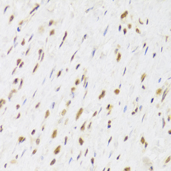 Immunohistochemistry of paraffin-embedded Human gastric cancer using RUVBL1 Polyclonal Antibody at dilution of  1:100 (40x lens).